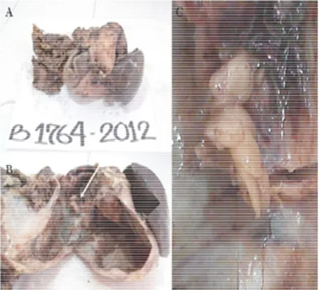 Figure 4. A: it is a panoramic view of a gross retroperitoneal tumor, a leiomyosarcoma