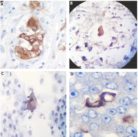 Figure 6. Neuron-specific enolase immunostaining analysis. A immunopositivity in a self-assembled embryoid body structure inside a hexagonal geometric pattern in a case of lung carci- noma (10×); C is a micrograph revealing enolase