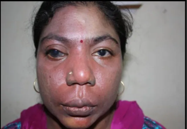 Figure  2  Right  and  left  lateral  view  of  hyperpigmented macules over face. 