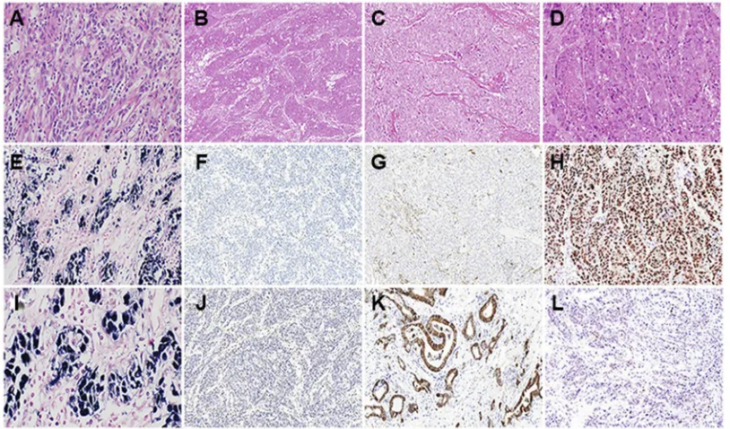 Figure 1 IdentiMSI (TCGA or ACRG), C3 to GS (TCGA) or MSS/EMT (ACRG), C4 to CIN (TCGA) or MSS/TP53- (ACRG), and C5 to MSS/TP53+(ACRG).Abbreviations:Barr Virus; MSI, microsatellite instability; MSS/EMT, microsatellite stable/epithelial mesenchymal transitio