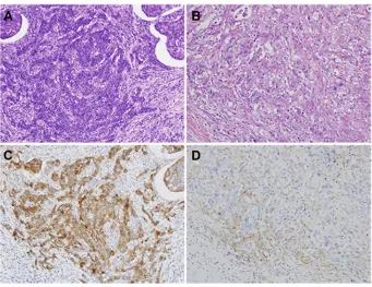 Figure 5 Expression of PD-L1 on gastric cancer. (A and C) Strong PD-L1 expression was observed in tumor cells and surrounding tumor embolism
