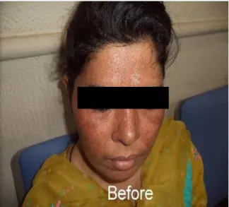 Figure 2 Patient of melasma at baseline (0 weeks). 