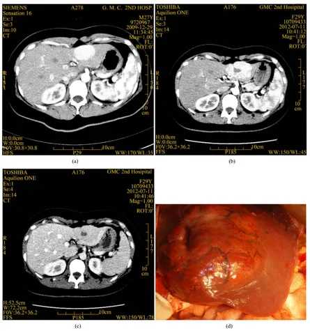 Figure 3. Surgical resection of FNH resulted in unsuccessfully PMC. Graphs showing a 27 years old young woman with a mass located in the Couinaud segment II and III of the liver