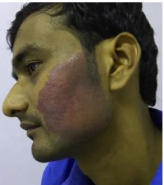 Figure 1 Borderline tuberculoid lesion over face. 