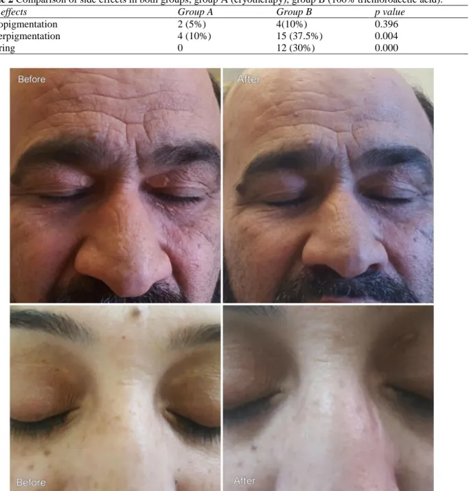 Table 2 Comparison of side effects in both groups; group A (cryotherapy), group B (100% trichloroacetic acid)