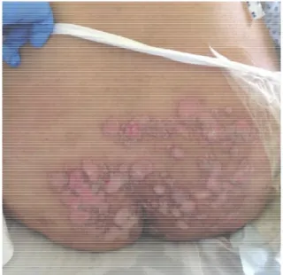 Figure  1.  Multiple  circinate  confluent  vegetating  erosive  eruptions  with  groups  of  blisters  over  buttocks following S1-S4 dermatomes.