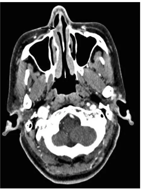 Figure 1 Enhanced CT showed ﬂaky, thickened soft tissue lesions (black arrow) onthe right side of the nasal septum.
