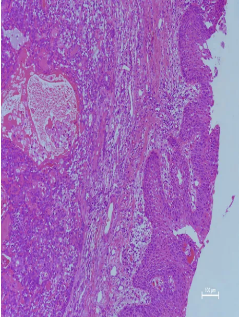 Figure 4 Microscopic examination revealed that the respiratory lining epitheliumand subepithelium contained a mixed tumor