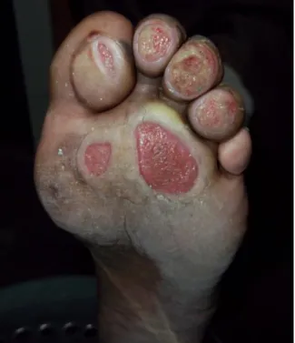 Figure  2  Figure  showing  multiple  pressure  foot  ulcers. 