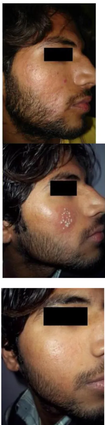 Figure 1a Acne scars along with few active lesions. 