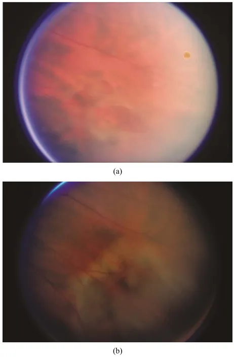 Figure 5(a) (b)therapy just outside of the tear to wall off the break. The 