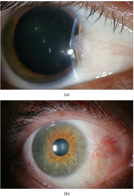 Figure 2. (a) Pterygium before excision and cryotherapy; (b) Appearance of eye 1 year after excision and cryotherapy