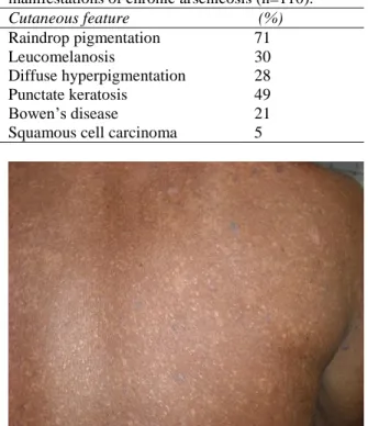 Figure  1  Raindrop  pigmentation  with  occasional  keratosis. 