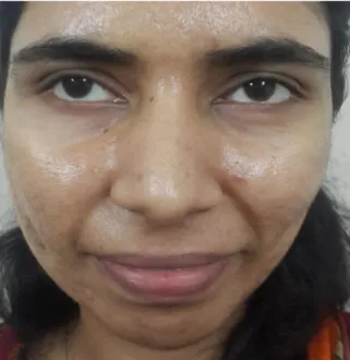 Figure  2  Marked  improvement  after  4-week  therapy  with topical brimonidine tartarate
