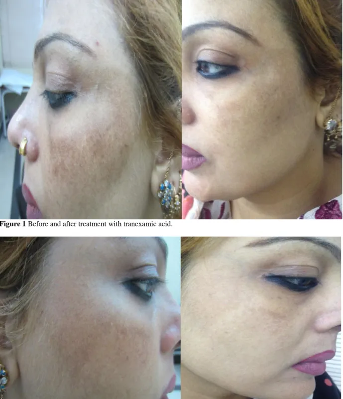 Figure 1 Before and after treatment with tranexamic acid. 