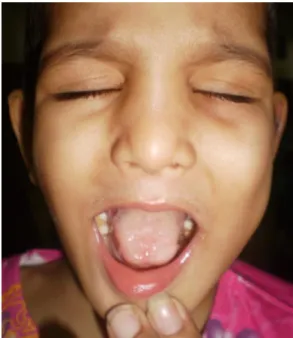 Figure 3 Multiple ulcers on hands. 