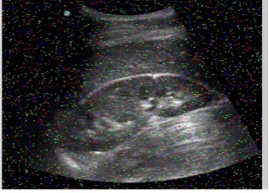 Figure 2 a) Normal and b) Abnormal kidney images B)  IMAGE PREPROCESSING 