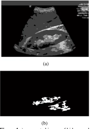 Figure 4(b)   a) segmented image of kidney and b) affected region of kidney 