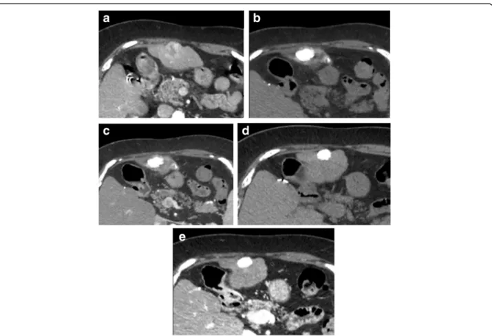 Fig. 4 Absence of local progression of an HCC showing a complete response according to mRECIST with complete lipiodol retention in an 83 yr- yr-old male with HBV related cirrhosis