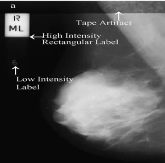 Figure 4.1: Types of noises example observed at a mammogram mdb002 in Mini-MIAS database (Suckling,  et al., 1994) 