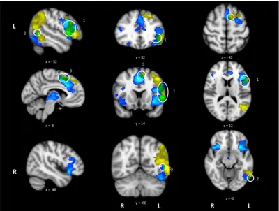 Fig. 3. Activation maps for high difﬁculty > low difﬁculty (blue/light blue) and action > visual (yellow), with the overlap in green