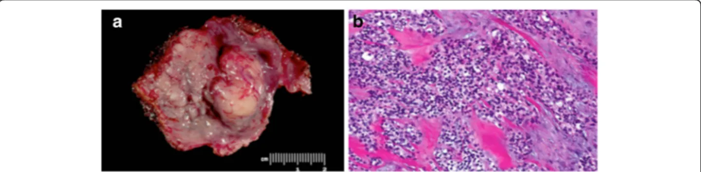 Fig. 1 Hyalinizing clear cell carcinoma. a Submucosal, rubbery, firm tumor of base of tongue