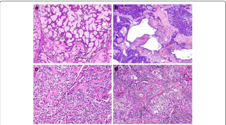 Fig. 2 Representative histological sections (hematoxilin and eosin stain) of minor salivary gland tumors found in the oropharynx in this series