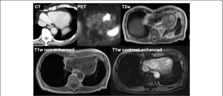 Table 3 Characteristics of myocardial lesions on 68Ga-DOTATA TE PET in NET patients