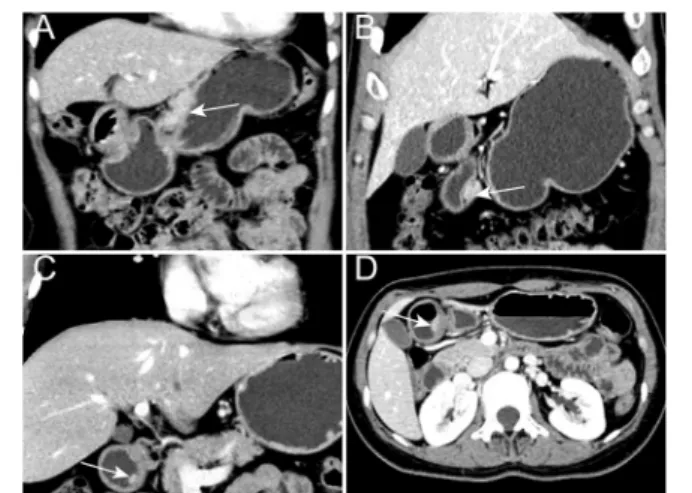 Fig. 3 Representative CT images in the venous phase of heterotopic pancreatic masses (white arrows)
