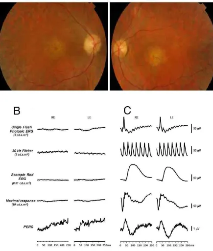 Figure S3. Clinical features of Case 1325 with a diagnosis of retinal dystrophy and early maculopathy