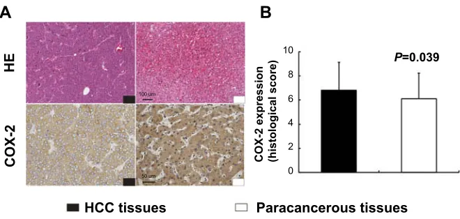 Figure 1 Expression of COX-2 in human hepatocellular carcinoma (HCC) tissues and paracancerous tissues
