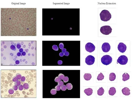 Table 1: the morphological features in normal, myeloblastic and Lymphoblastic cells 