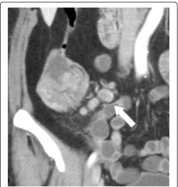 Fig. 3 Transaxial reformation (5 mm section post iv contrast portal phase) CT image illustrating the apperance of a 7 × 7 mm mesocolic lymph node (white arrow) in region 2 with irregular outer border and internal heterogeneity in a patient with a pT3 tumou