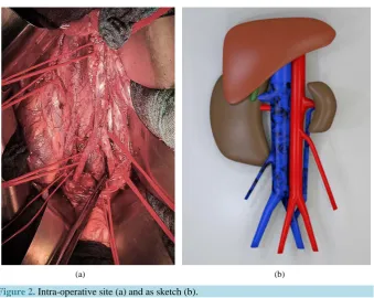 Figure 1. Thrombosis of right renal vein extending to the inferior vena cava (a) and (b)