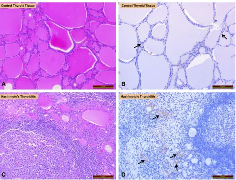 Figure 1 Comparison of irisin expression in hashimoto(irisin staining). (’s thyroiditis and thyroid tissues of controls