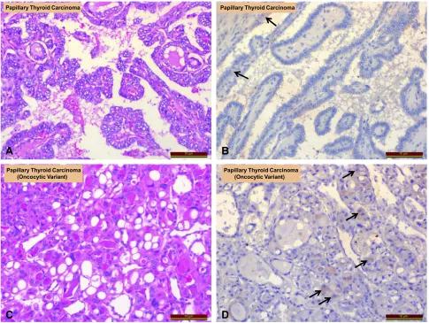 Figure 2 Comparison of irisin expression in papillary thyroid carcinoma and oncocytic papillary carcinoma