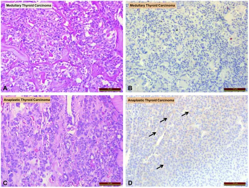 Figure 4 Comparison of irisin expression in medullary thyroid carcinoma and anaplastic thyroid carcinoma