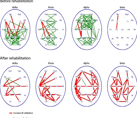 Figure 4. Regional characteristics of coherence changes (p < 0.01) for different EEG rhythms in Group 1 (n = 20) before RC-ST as compared with healthy subjects (n = 20) - top row and coherence changes in this patients after RC-SP as com- pared with pre-RC-