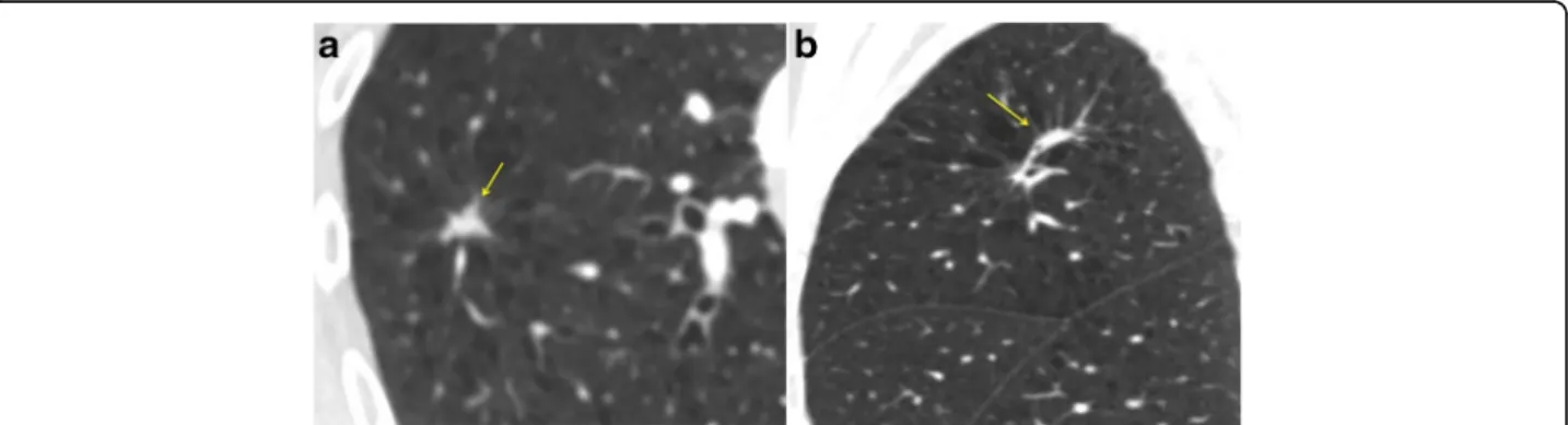 Fig. 1 a Axial CT shows a possible spiculated 10x8 mm nodule (arrow). b On the Coronal reformat the lesion is ‘flat’ and likely represents focal scarring/linear atelectasis and is not suitable for DCE-CT (arrow)