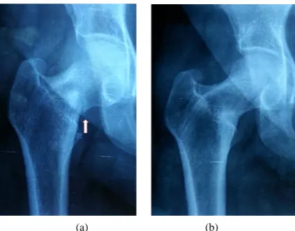 Figure 1. (a): Plain X-ray showing the looser zone in the neck of the right femur (white arrow)