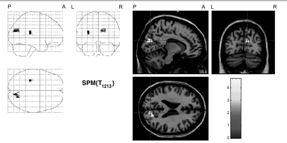 Figure 2. Reasoning about visual relations, that is, those that are easy to visualize but hard to envisage spatially, additionally activated areas in thesecondary visual cortex corresponding to V2