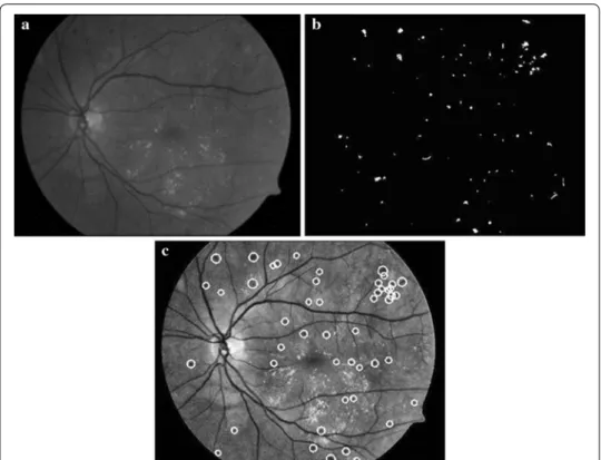 Fig. 6  Hemorrhages detection results based on k-means clustering and SVM. a Enhancement result