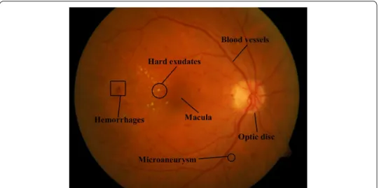 Fig. 1  Illustration of main structures and early lesions in color fundus image