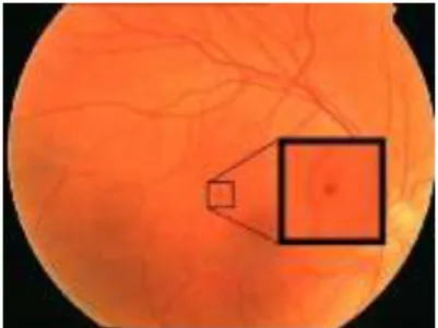 Figure 3: Microaneurysms in DR  