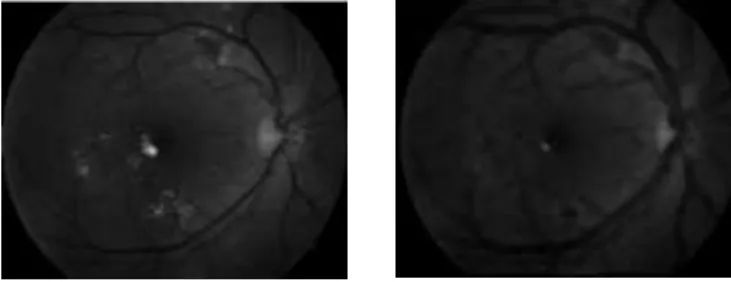 Figure  7(a) shows original  fundus  image before thresholding  with  CLAHE.  Figure 7(b) shows the  same image  with  too high threshold value resulting in too much  background information