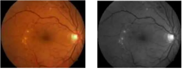 Figure 11: Original Fundus Image (left) &amp; Green channel  Image (right) 
