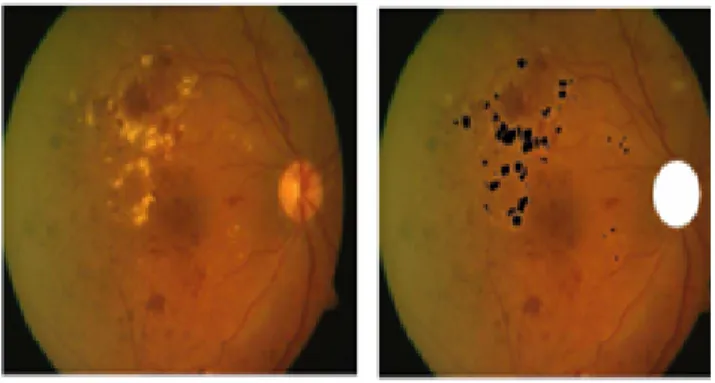 Figure 1. Result of exudates detection [1]