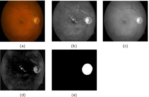Figure 3. Original Retinal Image, (b) Enhanced Image(I ce ), (c) Gray scale Image(I gs ), (d) Subtracted Image(I s ) and (e) Mask for OD Elimination