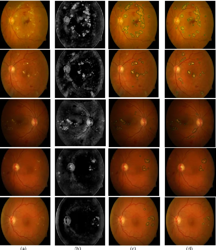 Figure 6. a) Original Retinal Image, (b) Output of Preprocessing algorithm, (c) Output of Kirsch algorithm,(d) Output of LBG algorithm