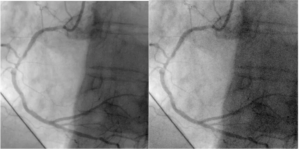 Figure 1. Single image frame from original angiogram (left) and with noise added to simulate 60% dose reduction (right).